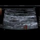 Crohn's disease of terminal ileum and colon: US - Ultrasound